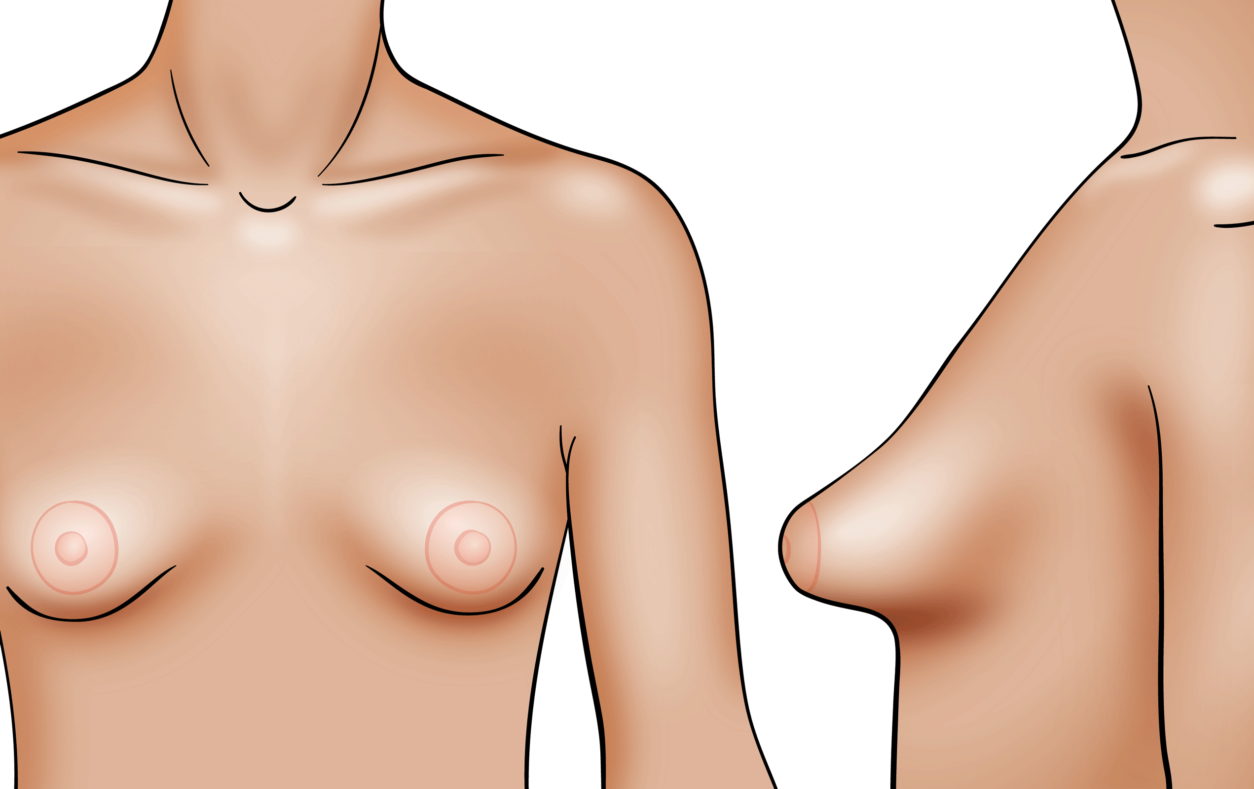 How to Fix Underdeveloped Breasts