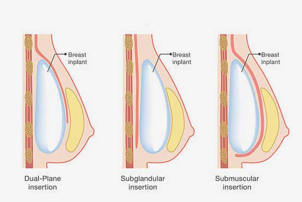 İmplant Yerleşim Yeri Neden Önemlidir? | Meme Büyütme