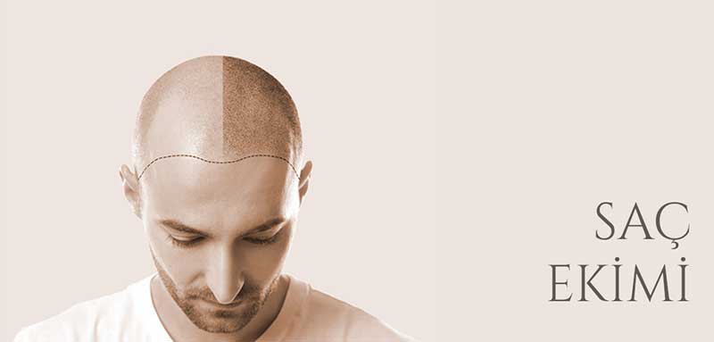 ПЕРЕСАДКА ВОЛОС ПЕРЕСАДКА ВОЛОС